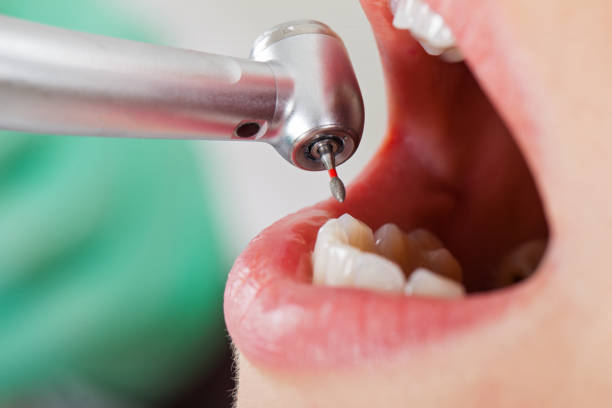 Best Emergency Root Canal Treatment in Gaffney, SC